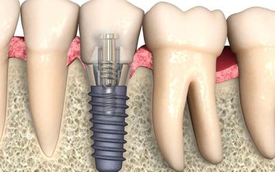 От чего зависит стоимость имплантации зубов?